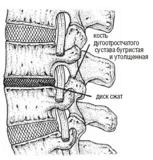 Дугоотростчатые суставы позвонков