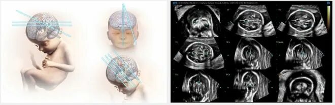Гидроцефалия нейросонография. Нейросонография головного мозга опухоль. Сонография головного мозга новорожденных. Микроцефалия у плода на УЗИ.