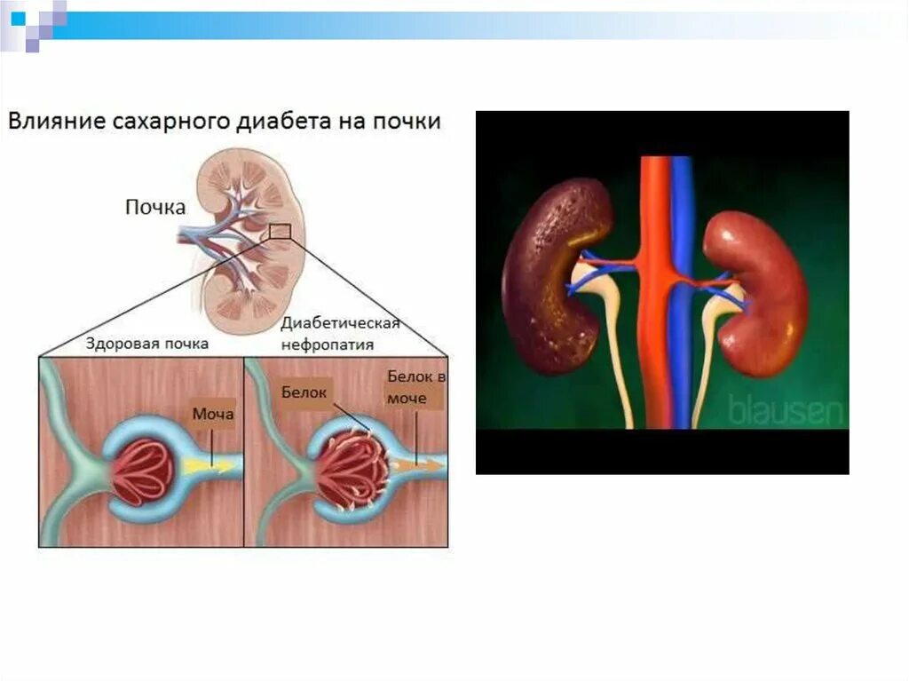 Почему в почках белок. Нефропатия сахарный диабет. Осложнения сахарного диабета. Хронические осложнения сахарного диабета.