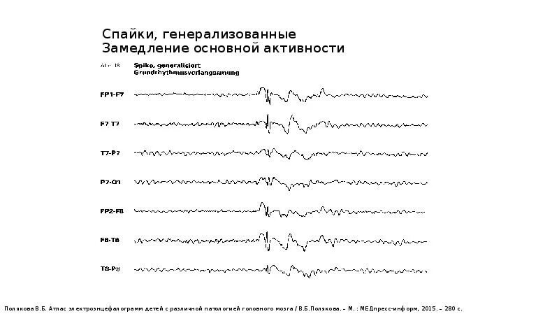 Спайк волна на ЭЭГ. ЭЭГ замедление основной активности. Генерализованная Спайк-волновая активность. Пик-волна пики и спайки на ЭЭГ. Спайк на ээг