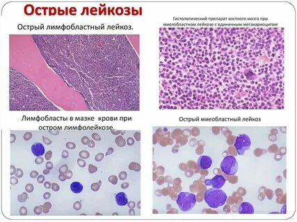 Костный мозг при лейкозе