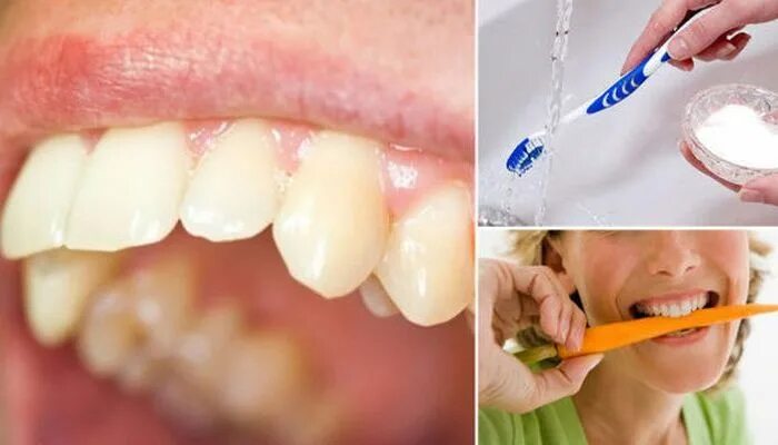 Как удалить зубную в домашних условиях. Зубной камень начальный этап.