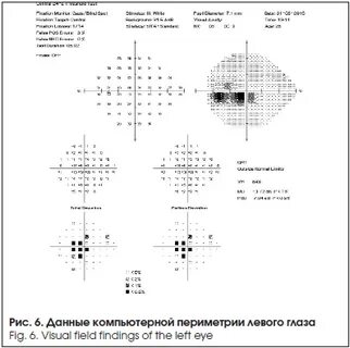 Компьютерная периметрия что это такое