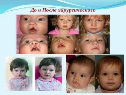 Ринолалия у детей