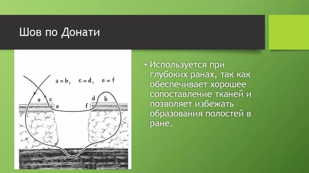 Вертикальный матрацный шов по донати. Вертикальный матрацный шов в хирургии. Вертикальный матрацный шов донати. Хирургический шов по донати. Вертикальный матрацный шов донати.