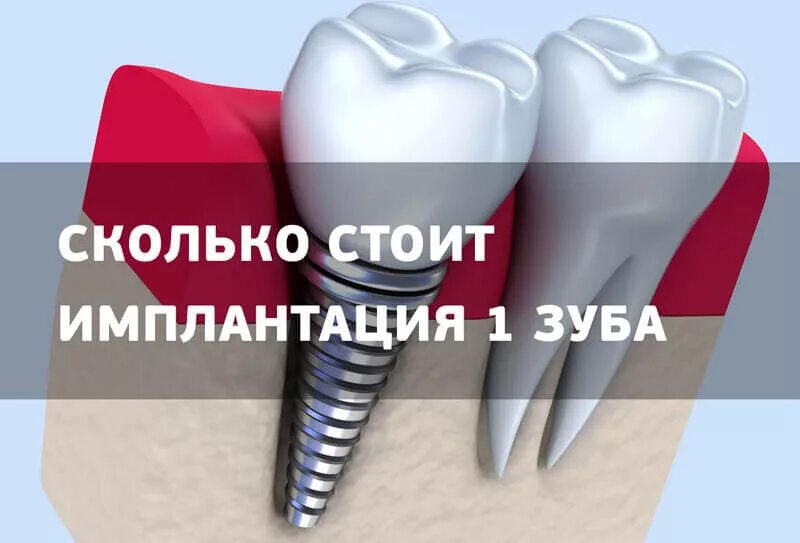 Сколько будет стоить 1 зуб