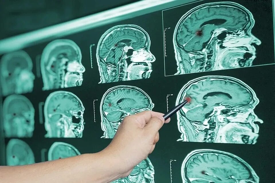 Сотрясение головного мозга. Поражение мозга лечится. Артериовенозная мальформация (авм). Аноксическая энцефалопатия. Поражение мозга лечится.