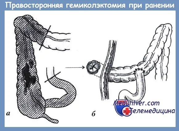 Резекция поперечно ободочной кишки. Гемиколэктомия этапы операции. Лапароскопическая гемиколэктомия. Правосторонняя гемикололэтомия. Обструктивная гемиколэктомия.