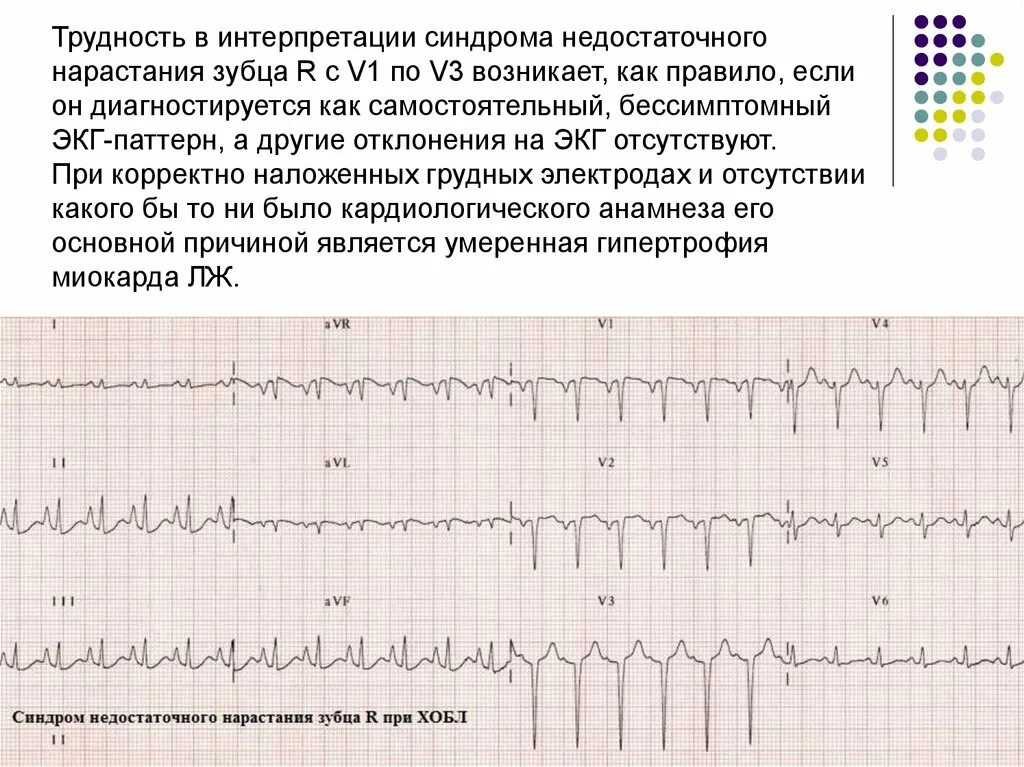 Отсутствие зубца r на ЭКГ В v1,v2,v3. Отсутствие нарастания зубца r в v1-v4. ЭКГ малый прирост зубца r в v1-v4. Нарастание зубца r в грудных отведениях.