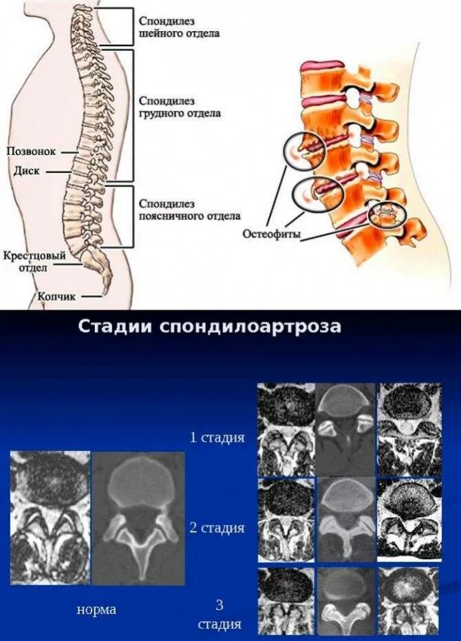 Дегенеративные изменения крестцового отдела. Спондилоартроз 2 степени грудного отдела. спондилоартроз поясничного отдела позвоночника что это такое. спондилоартроз th5 - th12.. деформирующий спондилез шейного отдела позвоночника 2 степени.