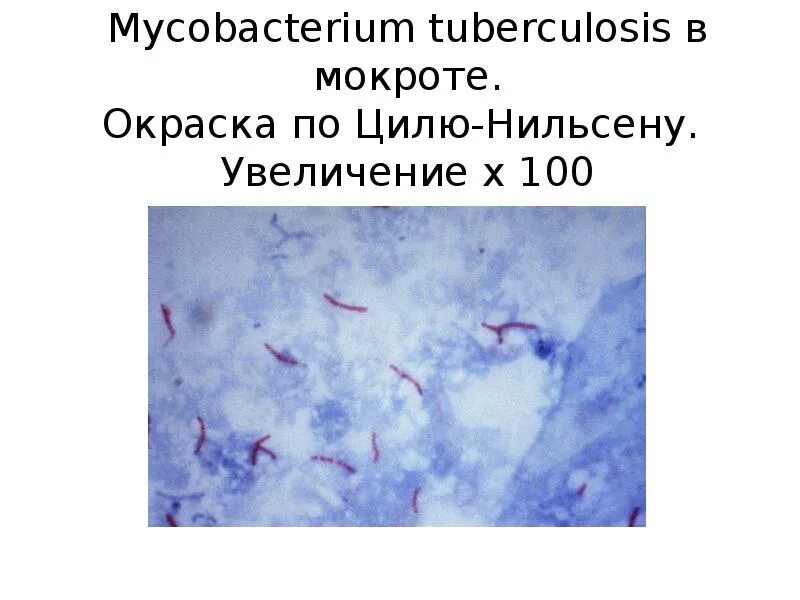 Туберкулез циль нильсену. Микроскопия мокроты по Цилю-Нильсену. Mycobacterium tuberculosis в мокроте окраска по Цилю Нильсену. Палочка Коха по Цилю-Нильсену. Mycobacterium tuberculosis Циль-Нильсен.