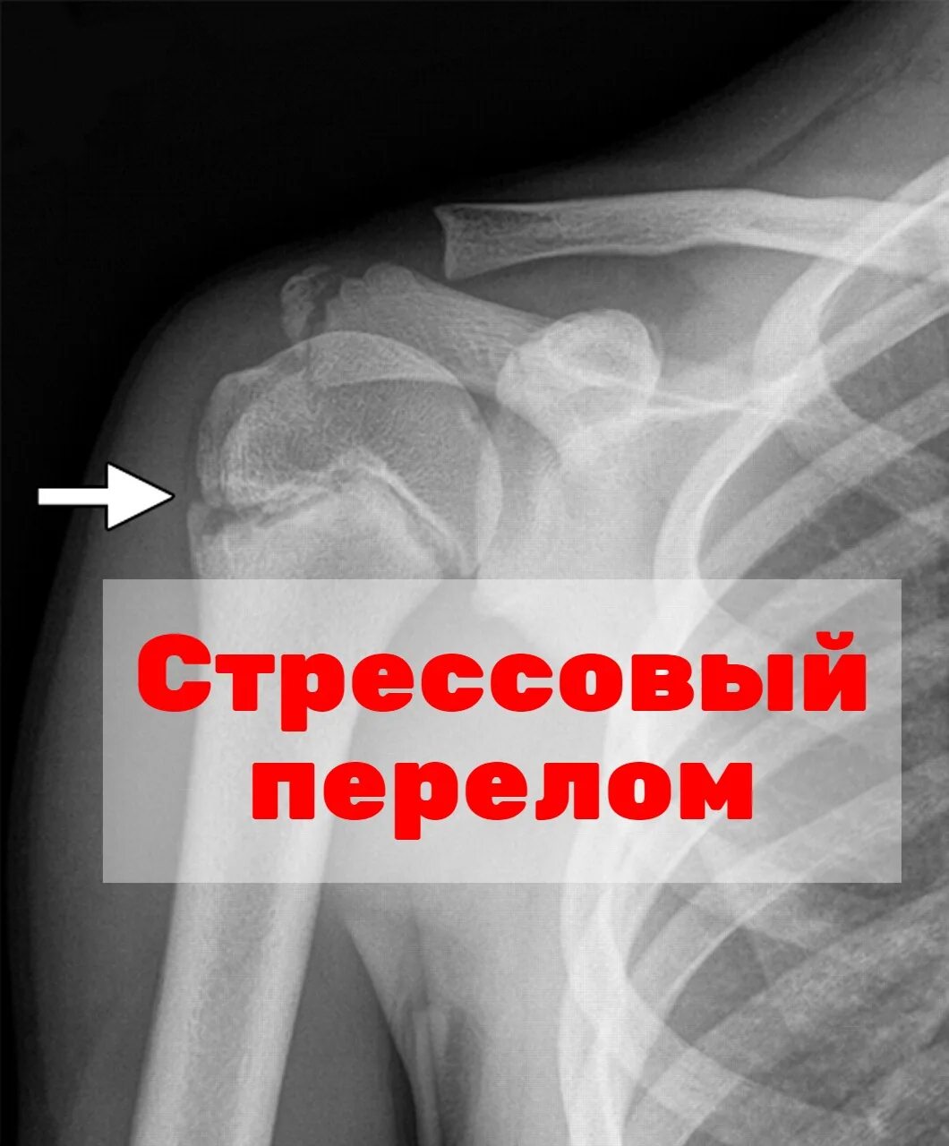 Стресс перелом большеберцовой кости рентген. Авульсионный перелом 5 плюсневой кости. Стресс перелом это. Стрессовый перелом 5 плюсневой кости. Стресс перелом большеберцовой кости кт.