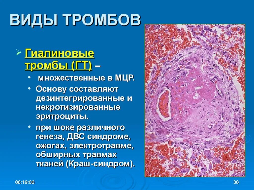 Гиалиновый тромб гистология. Фибриновый тромб гистология. Составные части гиалинового тромба. Виды тромбов. Части тромбов