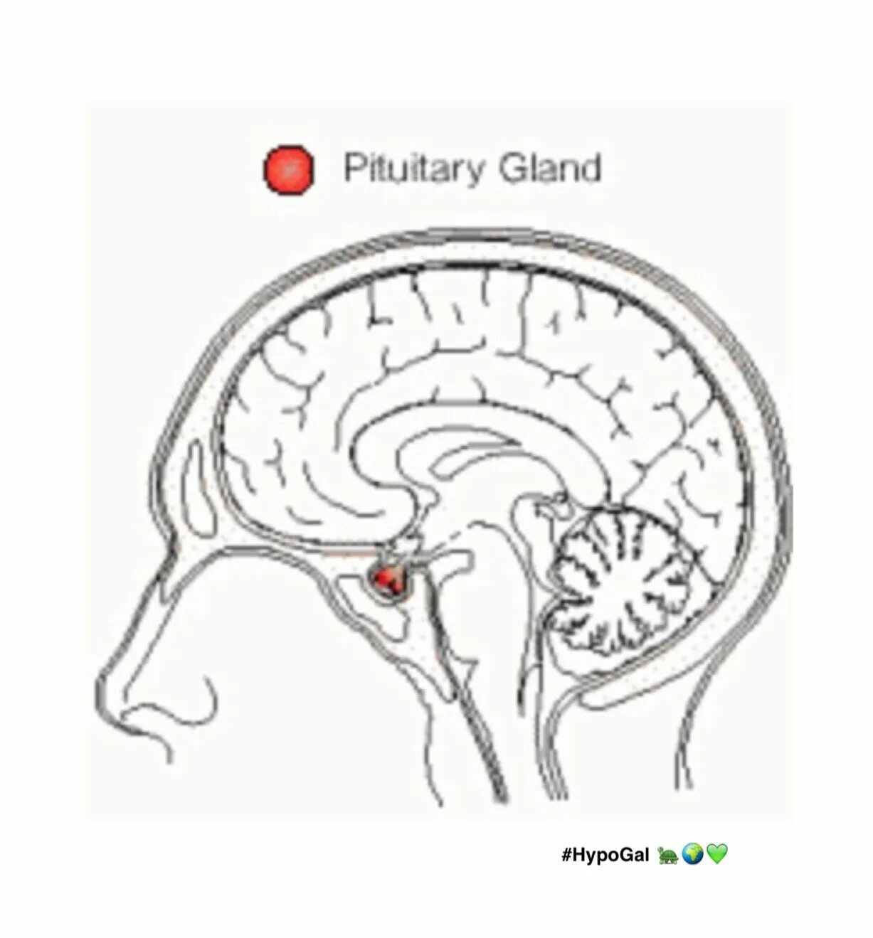 Гипофиз как улучшить его. Гипофиз в сагиттальной проекции. Расположение гипофиза в головном мозге. Опухоль гипофиза головного мозга.
