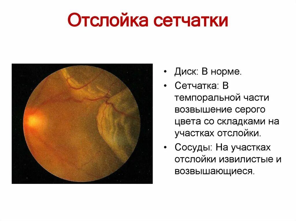 Отслойка сетчатки глаза офтальмоскопия. Первичная и вторичная отслойка сетчатки. Неопластическая отслойка сетчатки. Первичная отслойка сетчатки этиология.