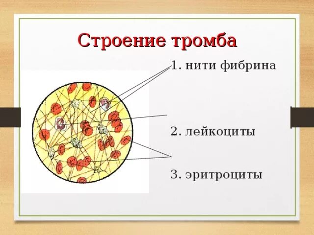 Состав тромба. Строение красного тромба. Структура тромба. Морфология тромба структура.