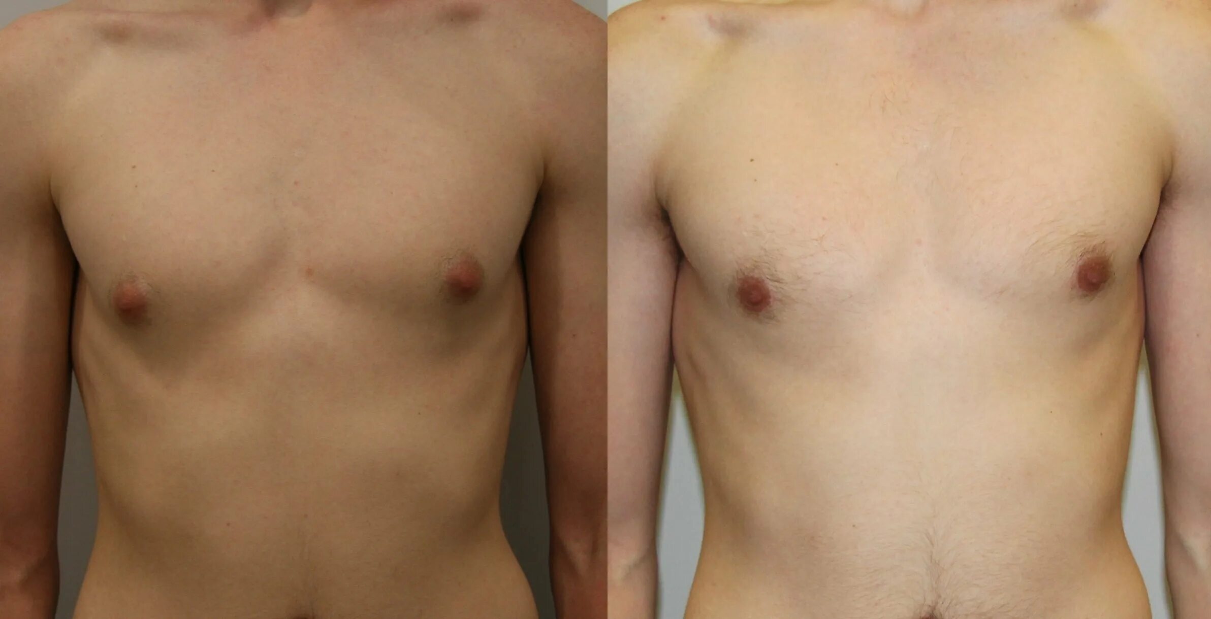 гинекомастия кломифен. у мальчика набухли молочные. у мальчика набухли молочные. у мальчика набухли молочные. у мальчика набухли молочные.