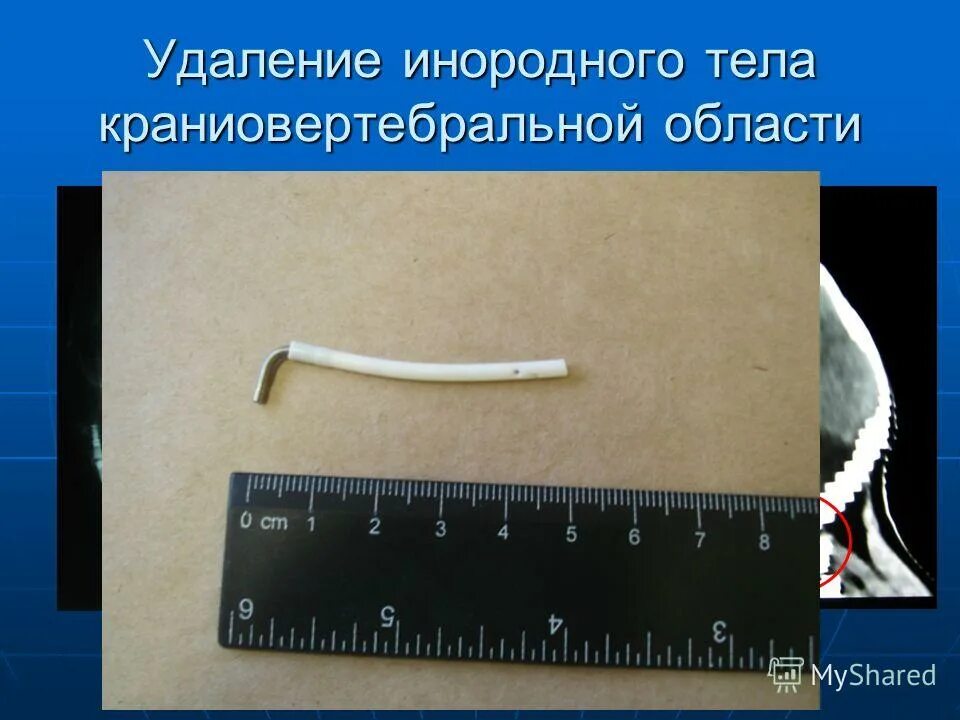 Удаление инородного тела. Удаление инородного тела алгоритм. методы удаления инородных тел из уха.