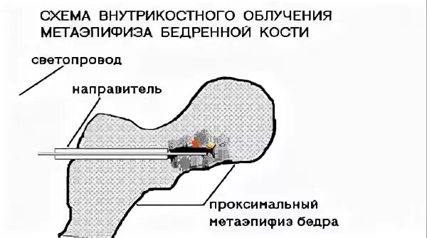 Внутрикостная блокада. Внутрикостный катетер. Внутрикостная инъекция.