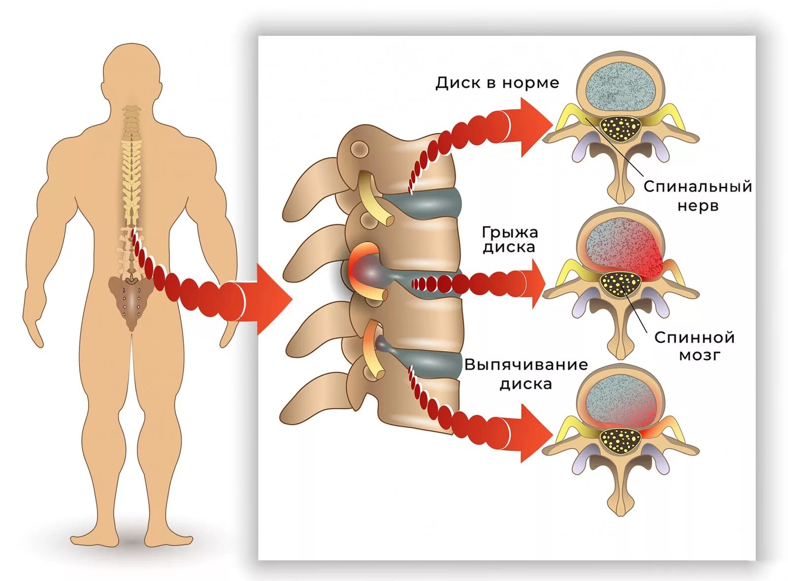 Грыжа позвоночника. Боль в позвоночнике. Боль в пояснице отдает в ногу. Отдает боль в позвоночнике. Боль в пояснице отдающая в левую
