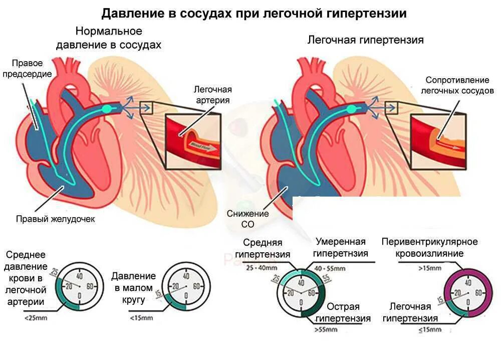 Первичная легочная гипертензия симптомы. Синдром легочной гипертензии патогенез. Легочная артериальная гипертензия симптомы. Повышение давления в легочной артерии.