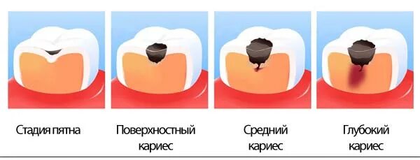 Глубокий кариес мкб 10. Поверхностный средний и глубокий кариес. кариес поверхностная стадия.