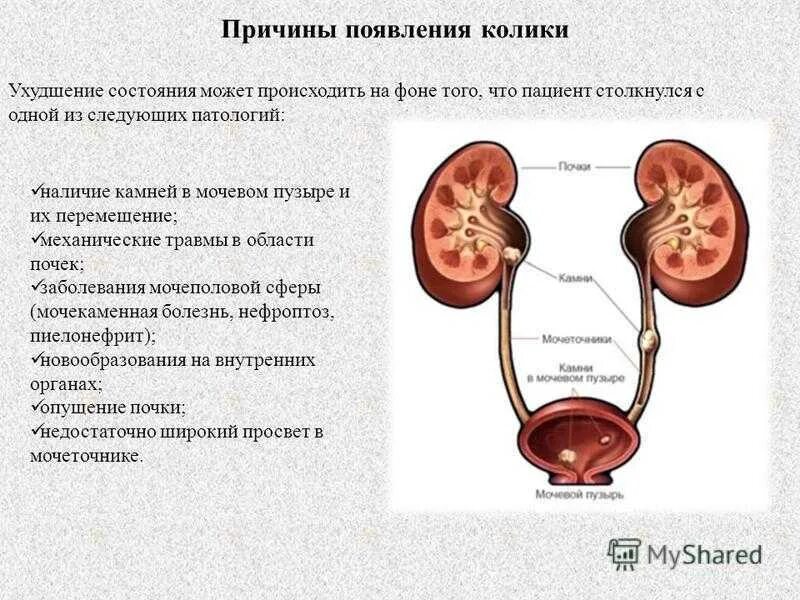 Почему лоханка. Почечная колика причины. Спастические сокращения мочеточника. Стенд в мочеточнике последствия. Заболевания органов мочевыделительной системы у детей.