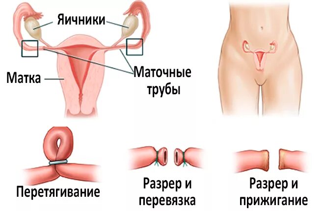 Перевязать трубы после родов. Хирургическая стерилизация маточных труб. Как выглядит перевязка маточных труб. Перевязка маточных труб название операции. Стерилизация как метод контрацептива.