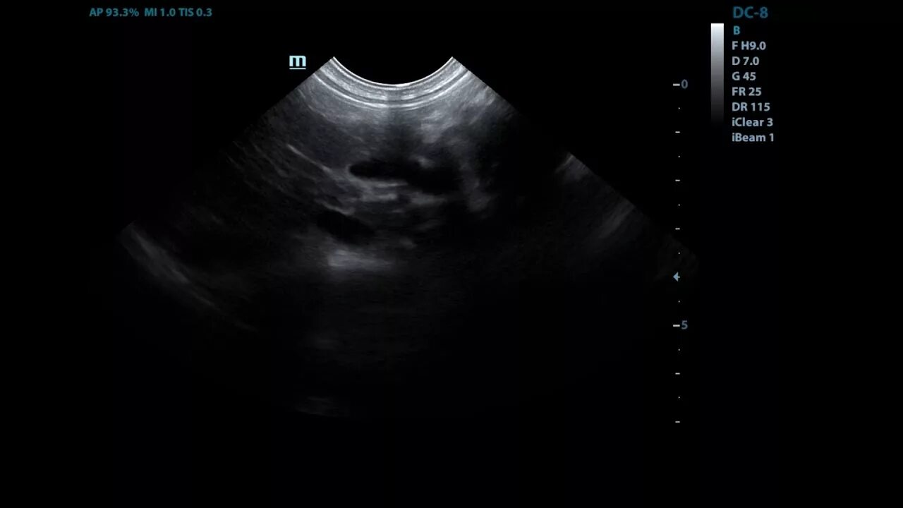 Портосистемные шунты УЗИ. Портосистемный шунт у собак УЗИ. Портальные шунты на УЗИ.