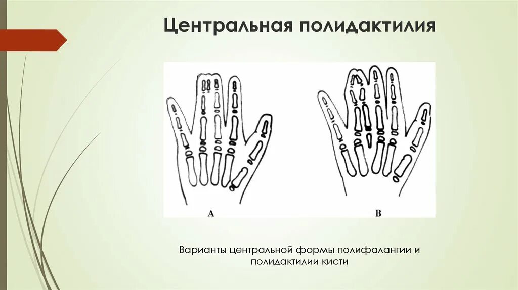 Полидактилия полифалангия классификация. Постаксиальная полидактилия кистей. Полидактилия пальцев кисти. Центральная полидактилия.