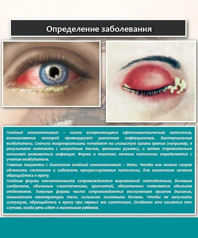 Капли глазные офиальмо. Бактериальныйконьюктевит. Симптомы конъюнктивита глаз. Капли от коньюктивита для детей флоксал. Офтальмоферон капли 10мл.