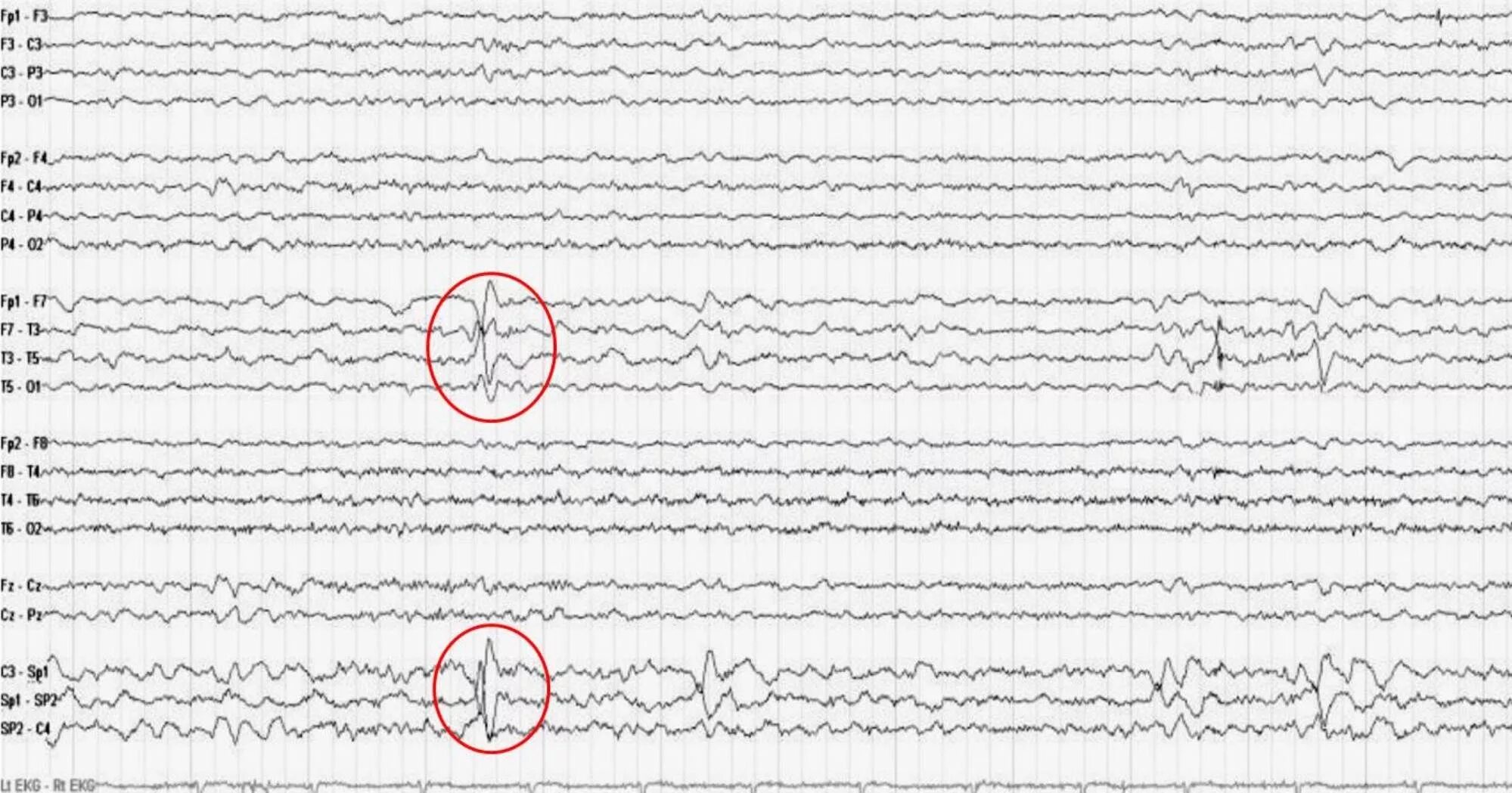 Эпилептические паттерны на ЭЭГ. ЭЭГ волны при эпилепсии. Эпилепсия на ЭЭГ У ребенка. ЭЭГ эпилепсия пик-волна. Как выглядит ээг