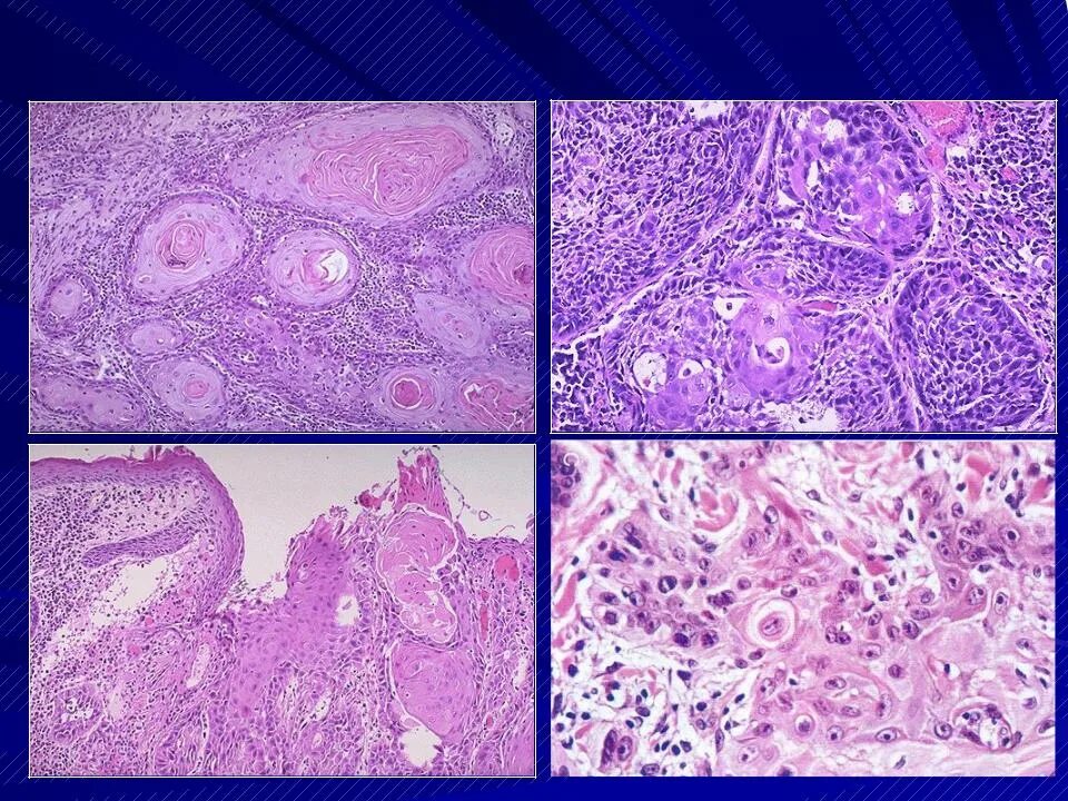 Плоскоклеточными опухолями. Плоскоклеточная карцинома g3. Ороговевающая карцинома. Амелобластома гистология. Плоскоклеточная карцинома гортани гистология.