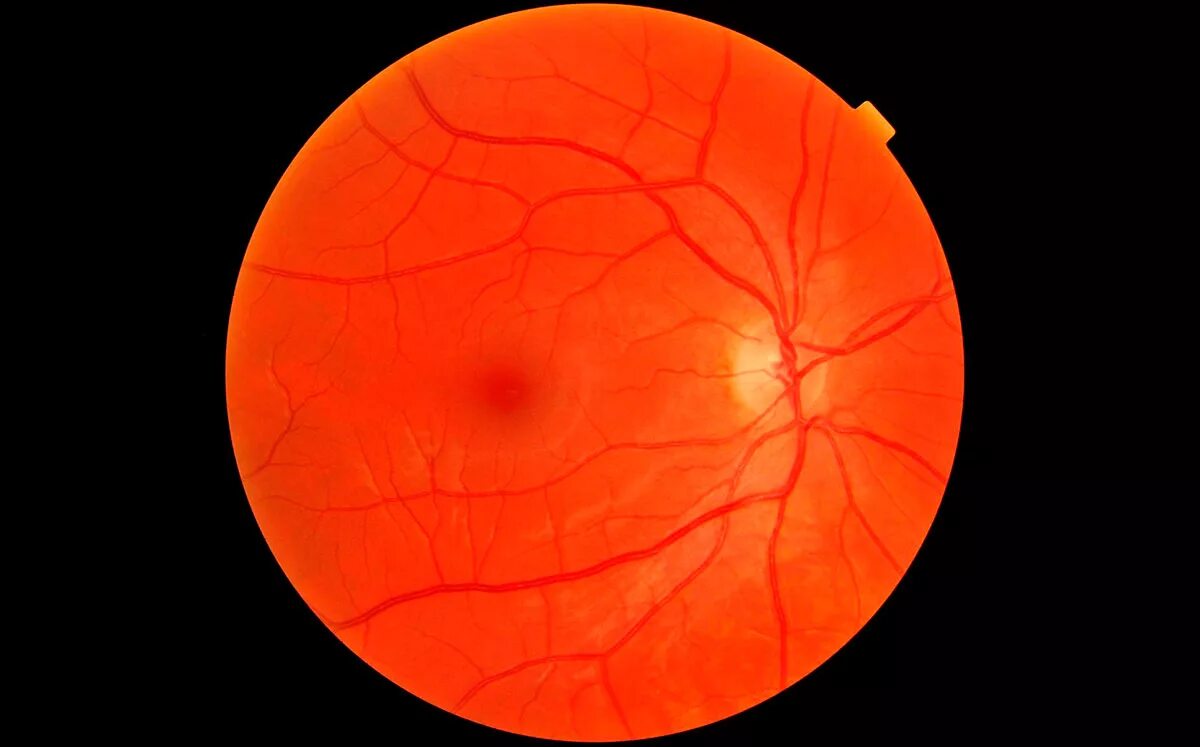 Гипертоническая ретинопатия. Гипертоническая ретинопатия сетчатки. Пролиферативная ретинопатия. Ишемическая ретинопатия. Ангиопатия сосудов сетчатки что это