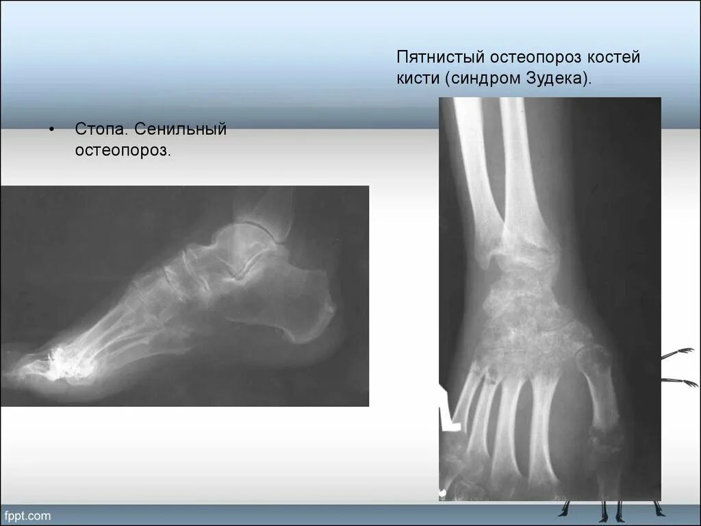 Изменения костной структуры