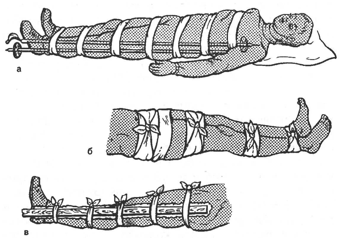 Помощь при открытом переломе бедра. Транспортная иммобилизация конечностей. Транспортная иммобилизация при переломах костей. Иммобилизация при переломе бедренной кости. Транспортная иммобилизация при переломе костей голени бедра.
