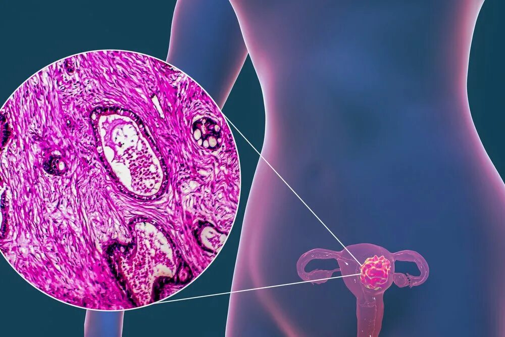 Аденокарцинома матки патанатомия. Эндометриоидная карцинома. Эндометриоидная аденокарцинома шейки матки. Эндометриоидная аденокарцинома g1 что это. Предраковое эндометрий