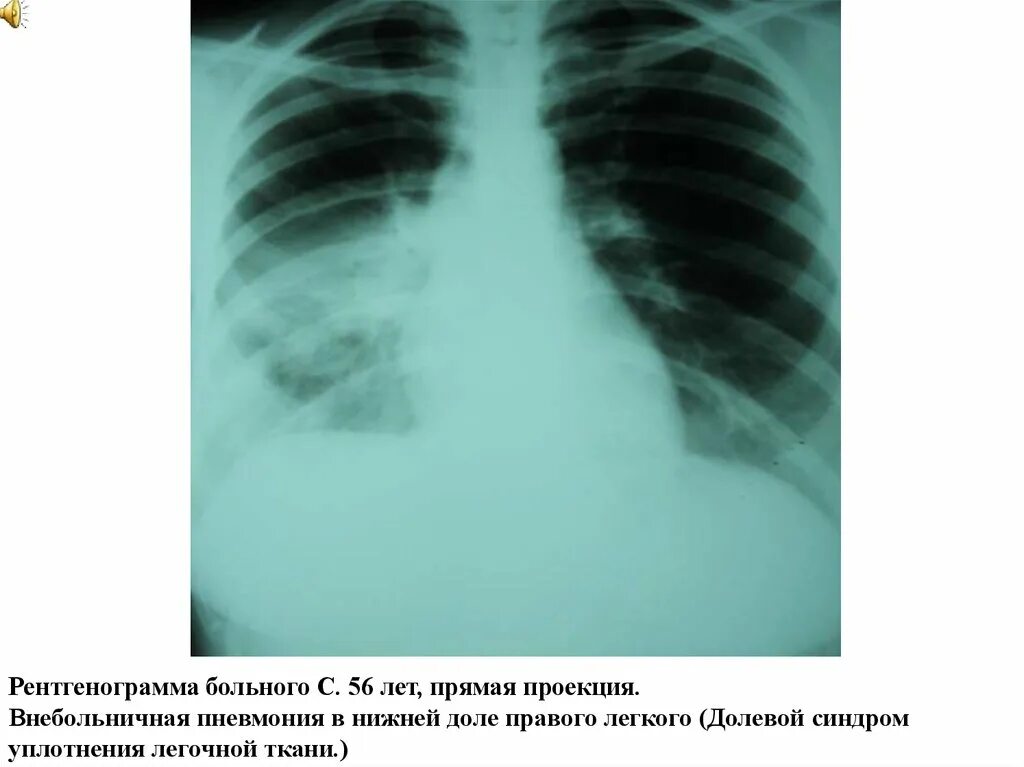 Пневмония в правой нижней доле. Долевая пневмония рентгенограмма. Внебольничная пневмония нижней доли правого легкого. Уплотнение нижней доли правого легкого. Синдром уплотнения нижней доли правого лёгкого пневмония.