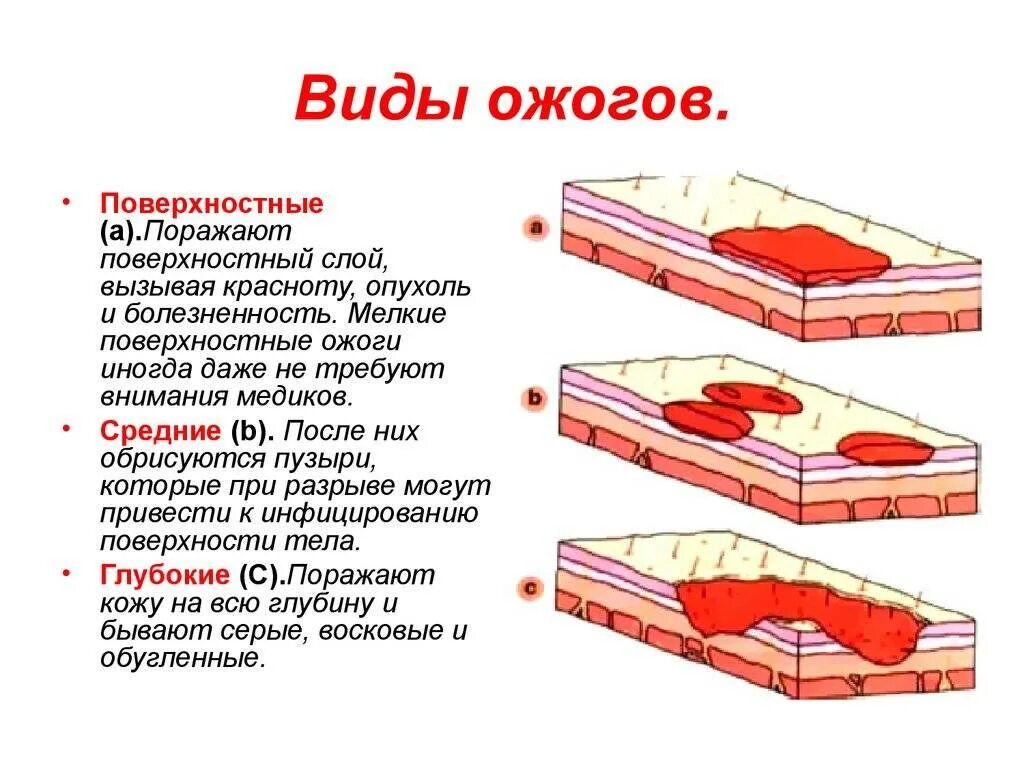 Какие степени термического. Кратко ожоги и степени ожогов. Ожоги классификация 1 степени. Степени поверхностных термических ожогов.