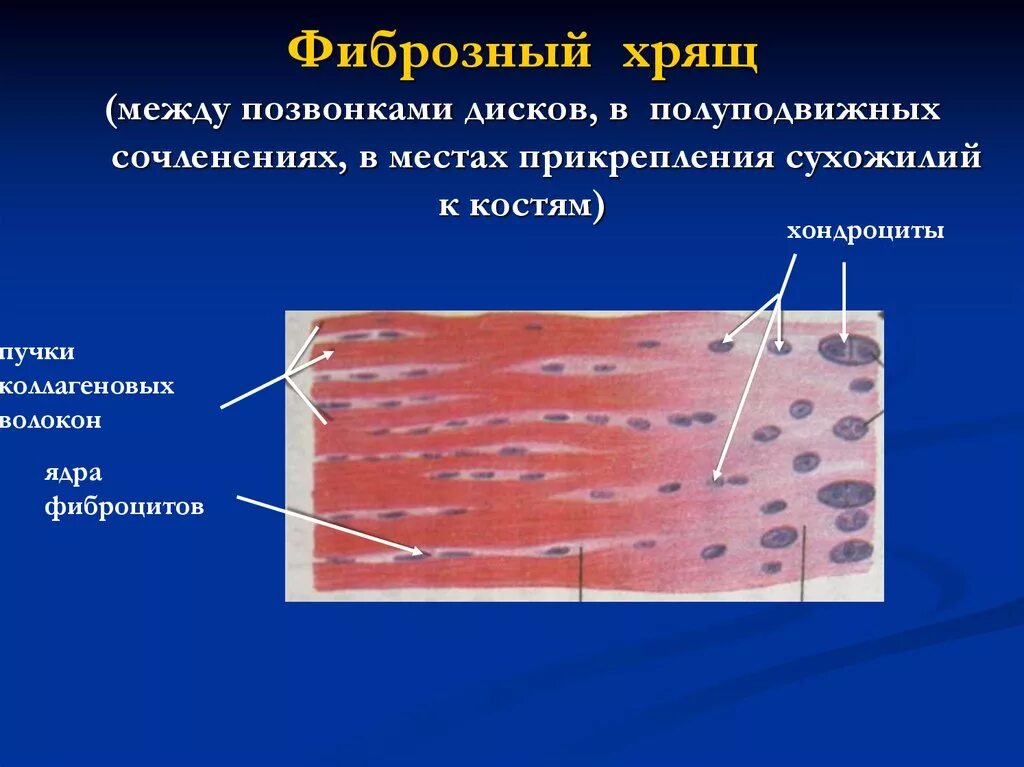 Что означает фиброзное изменение. Коллагеновый хрящ гистология. Волокнистый хрящ препарат гистология. Фиброзная ткань гистология. Волокнистый хрящ хрящ гистология строение.