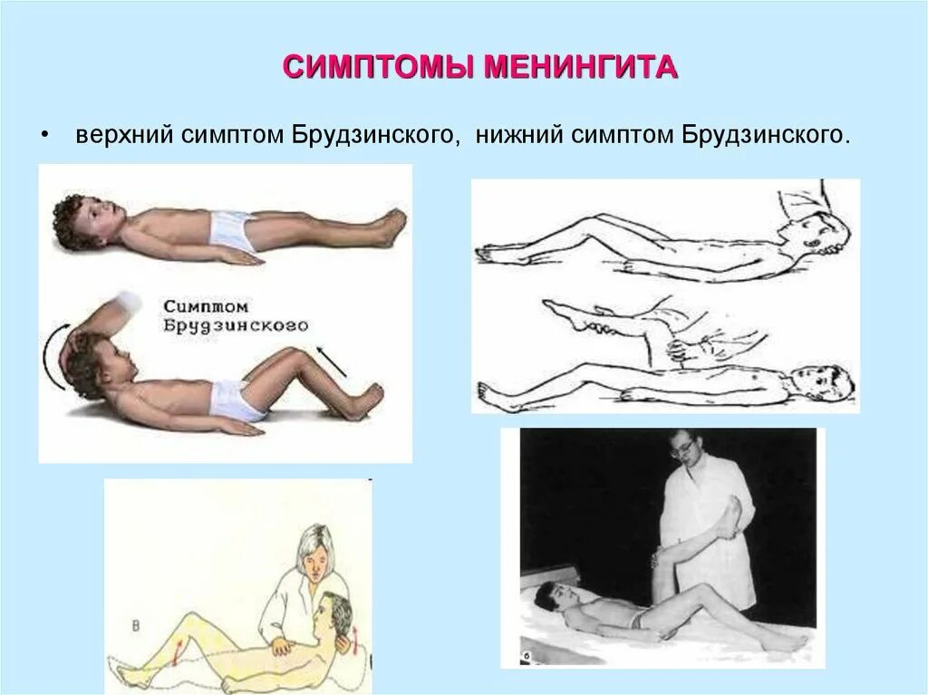 Симптомы менингита у человека. Менингококковая инфекция ригидность. Нижний менингеальный симптом Брудзинского. Менингит симптом Брудзинского Нижний. Менингеальные симптомы менингита.