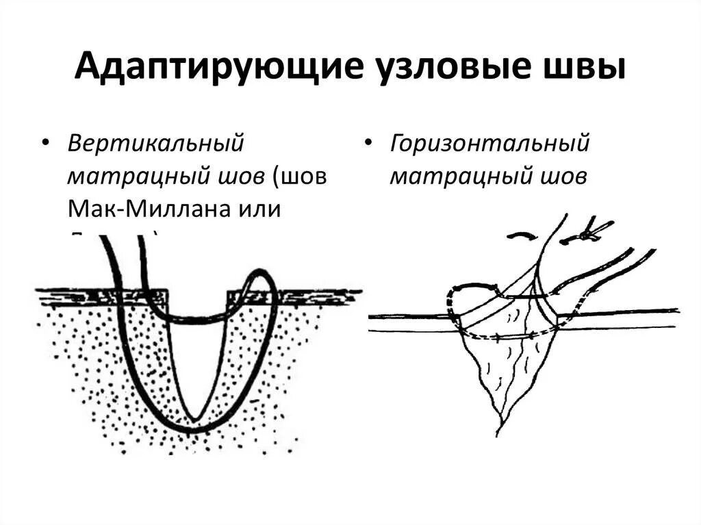 Узловой горизонтальный матрацный шов. Вертикальный и горизонтальный шов хирургия. Горизонтальный и вертикальный матрацный шов. Вертикальный матрацный шов Донати. Чем обработать операции швы можно