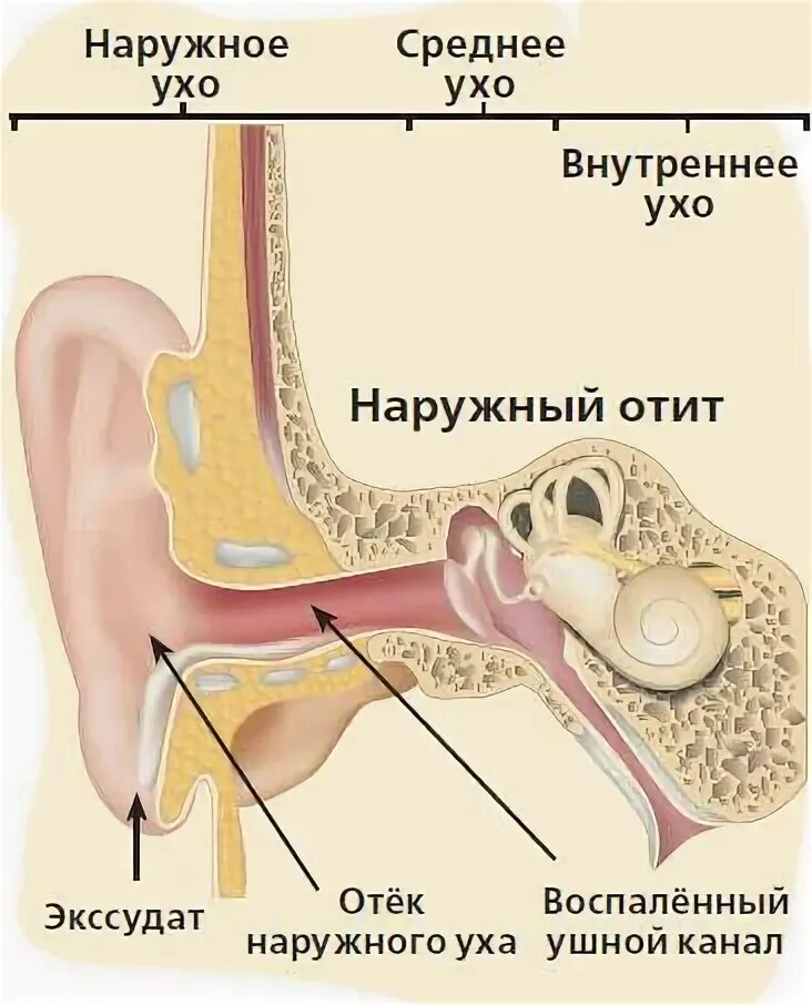 Попадания воды в среднее ухо. Вода попала в среднее ухо. Что делать если в ухе застряла вода