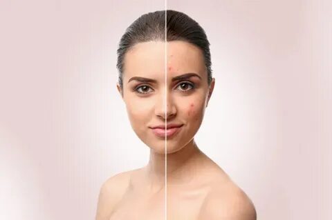 Acne removing