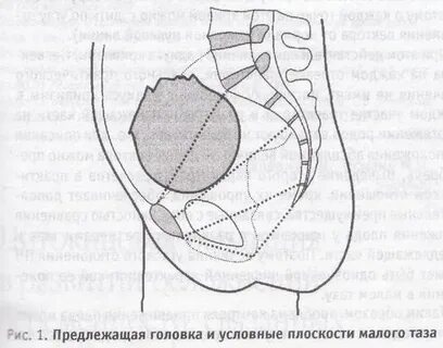 Прямой размер плоскости входа в малый таз