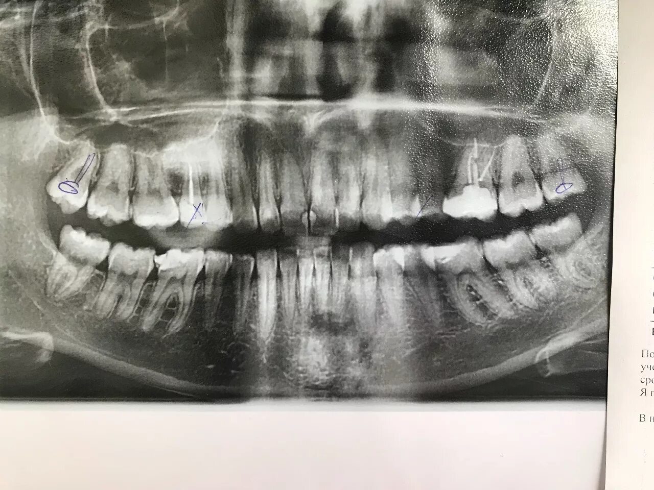 Снимок зубов видное. Ортопантомограмма челюсти. Ортопантомограмма кариес.