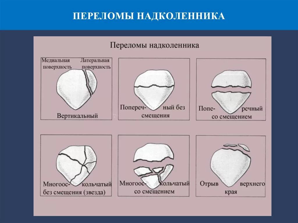 Закрытый краевой перелом надколенника. Продольный перелом коленной чашечки. Поперечный перелом надколенника. Вертикальный перелом надколенника. Перелом надколенника операции