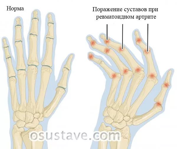 Изменения кисти рук