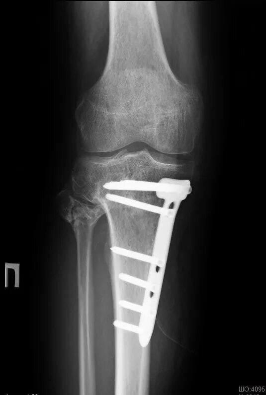 Остеосинтез мыщелка берцовой кости. Переломы мыщелков большеберцовой Кост. Перелом наружного мыщелка большеберцовой кости. Перелом мыщелка большеберцовой рентген. Остеосинтез мыщелка
