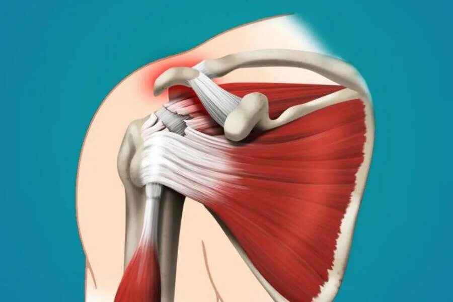 Ротаторная манжета плечевого сустава. Разрыв сухожилия на достные мышцы. Сухожилия ротаторной манжеты. Растяжение сухожилий надостной мышцы.